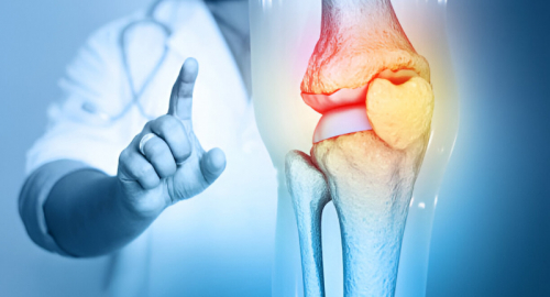 Osteoartrite e Metabolomica: Un'Analisi delle Vie Metaboliche e dei Biomarcatori per Nuove Strategie Terapeutiche